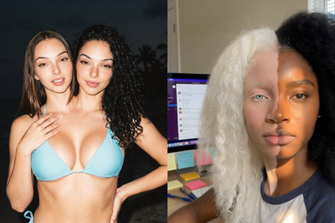 Design sem nome GÊMEAS SIAMESAS E QUIMERISMO